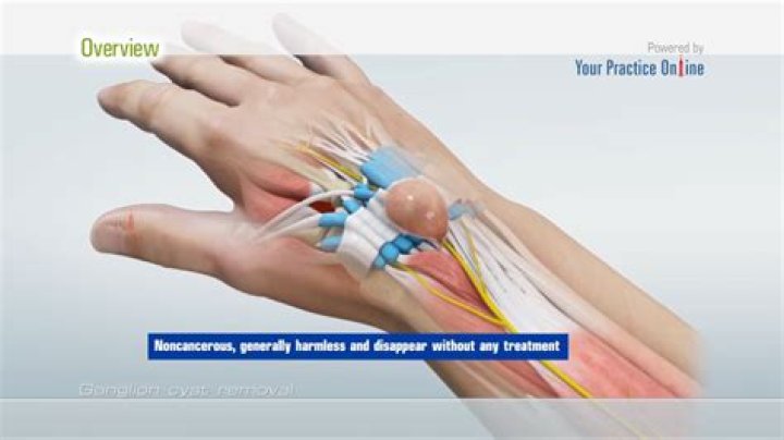 How do you get rid of a ganglion cyst on your wrist?