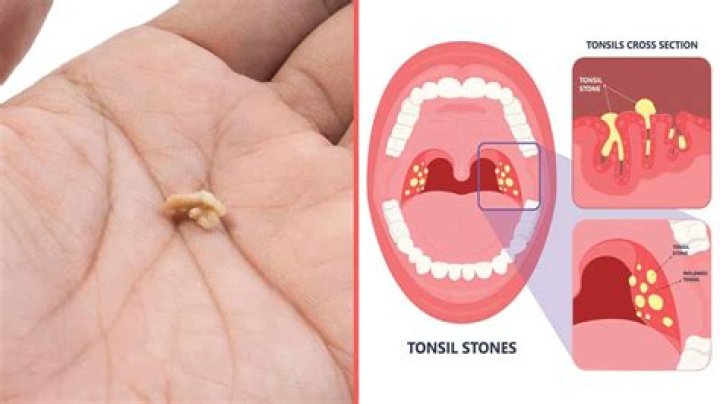 How do you get rid of deep tonsil stones?