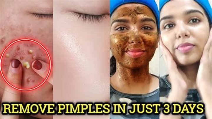 How do you get rid of pimples under your jaw?