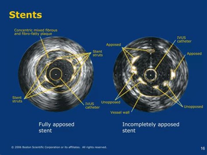 How do you size a IVUS stent?