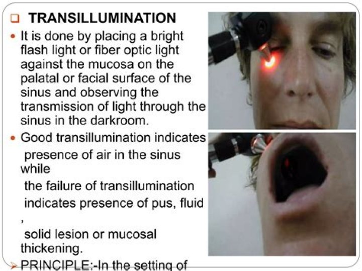 How do you Transilluminate the frontal sinuses?
