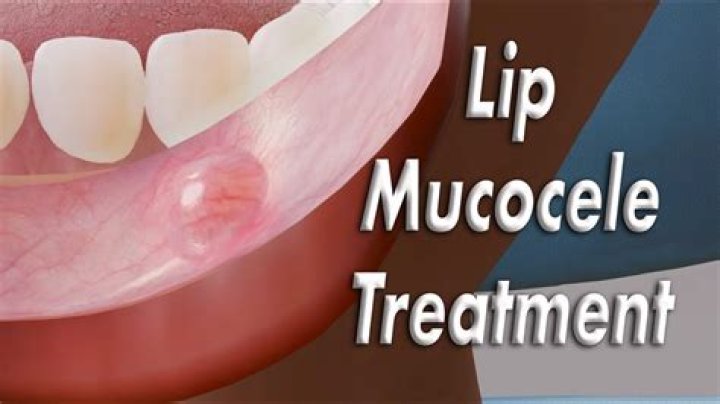 How do you treat a superficial mucocele?