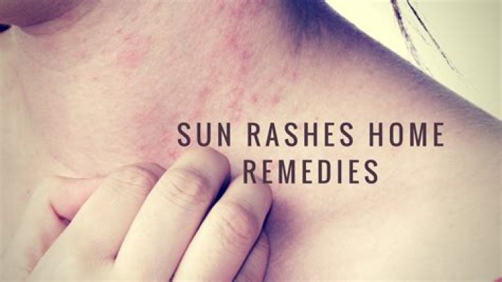 How do you treat sun rash blisters?