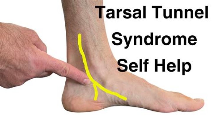 How do you treat tarsal tunnel syndrome?
