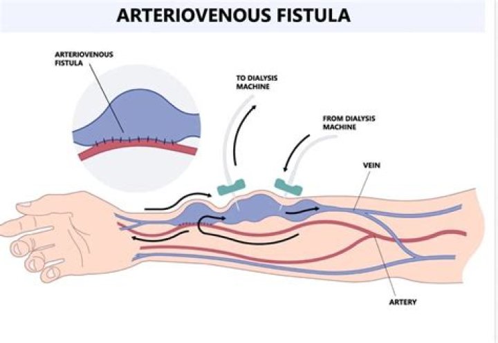 How does an AV fistula work?