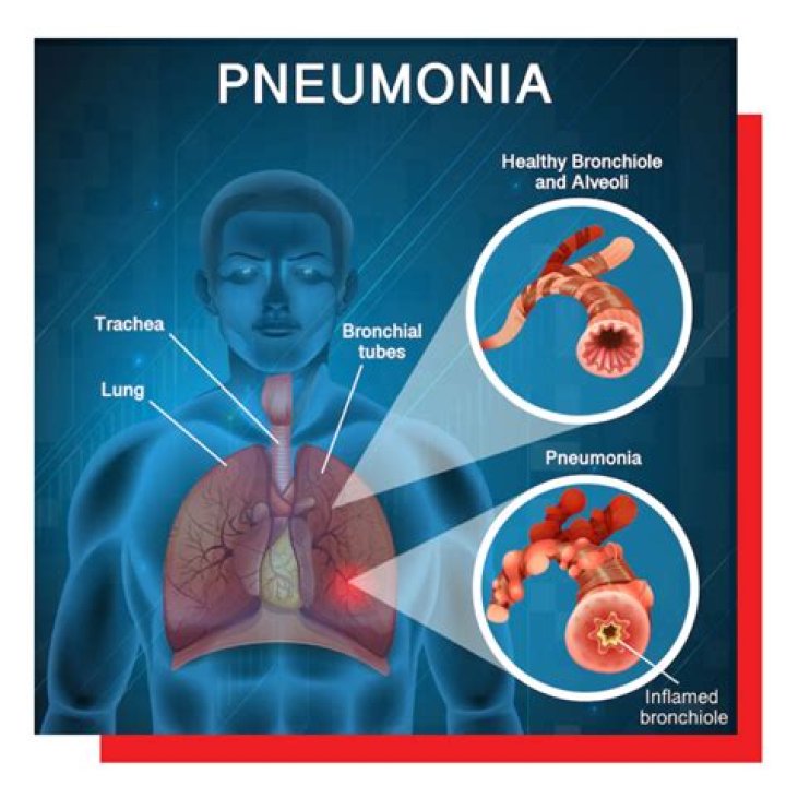 How does pneumonia affect asthma?