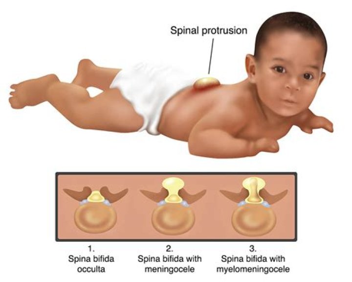 How does spina bifida lead to hydrocephalus?