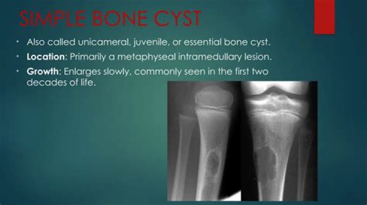 How is a simple bone cyst treated?
