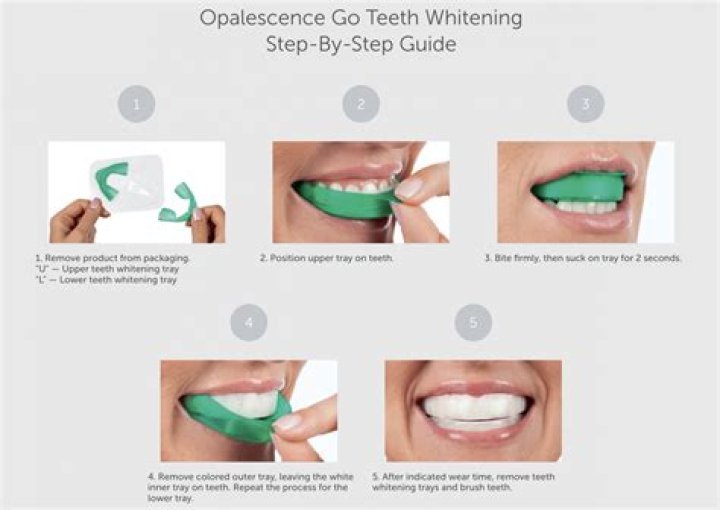 How long do you leave whitening gel on your teeth?