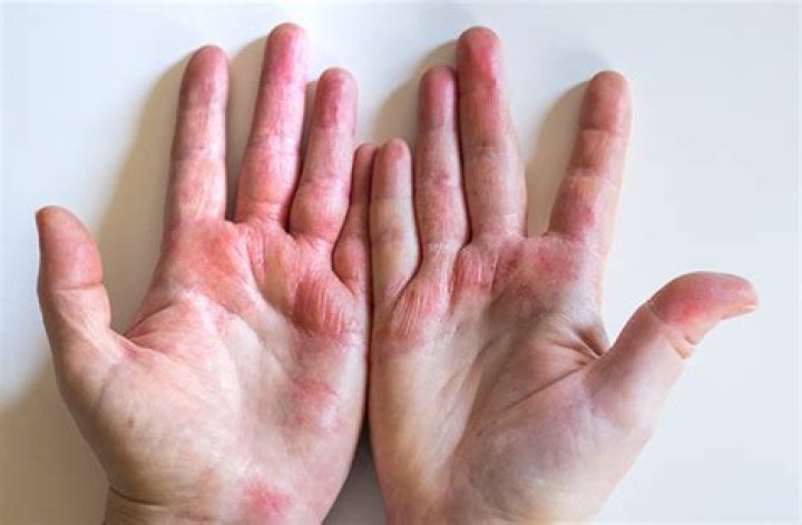 How long does capsaicin burn last on skin?