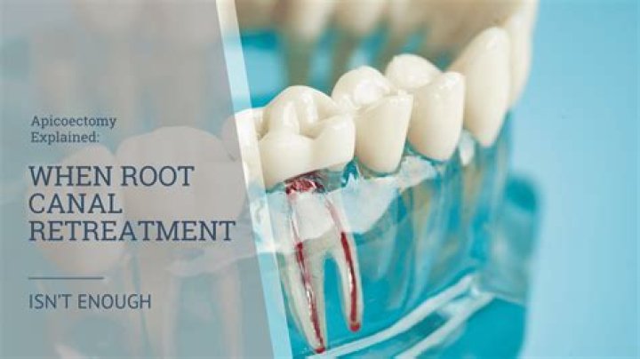 How long does it take for a gum to heal after apicoectomy?