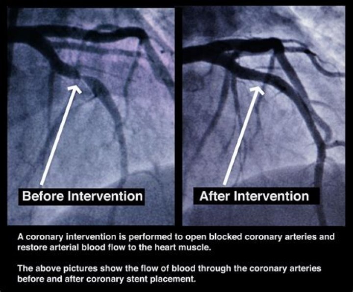 How long does it take to recover from an angiogram and stent?