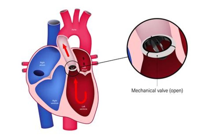 How long does it take to recover from mitral valve repair surgery?