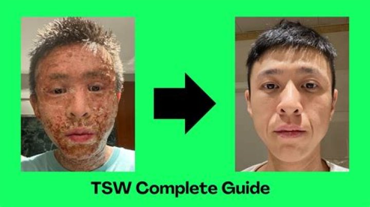 How long does it take to recover from TSW?