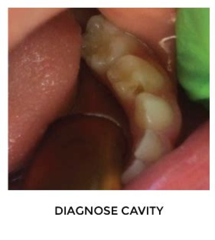 How long does SDF last on teeth?