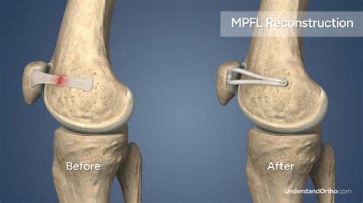 How long is recovery after Mpfl surgery?