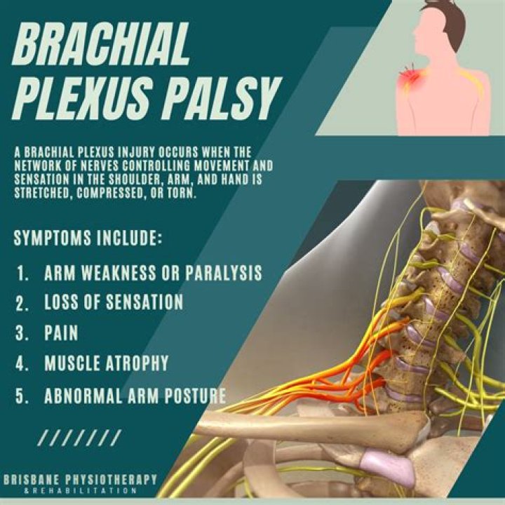 How long is recovery from brachial plexus surgery?