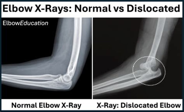 How long will it take to recover from a dislocated elbow?
