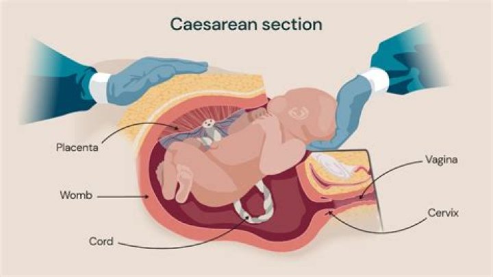How many C-sections can you have in a lifetime?