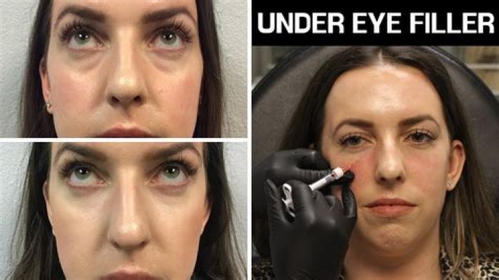 How much are Restylane fillers?