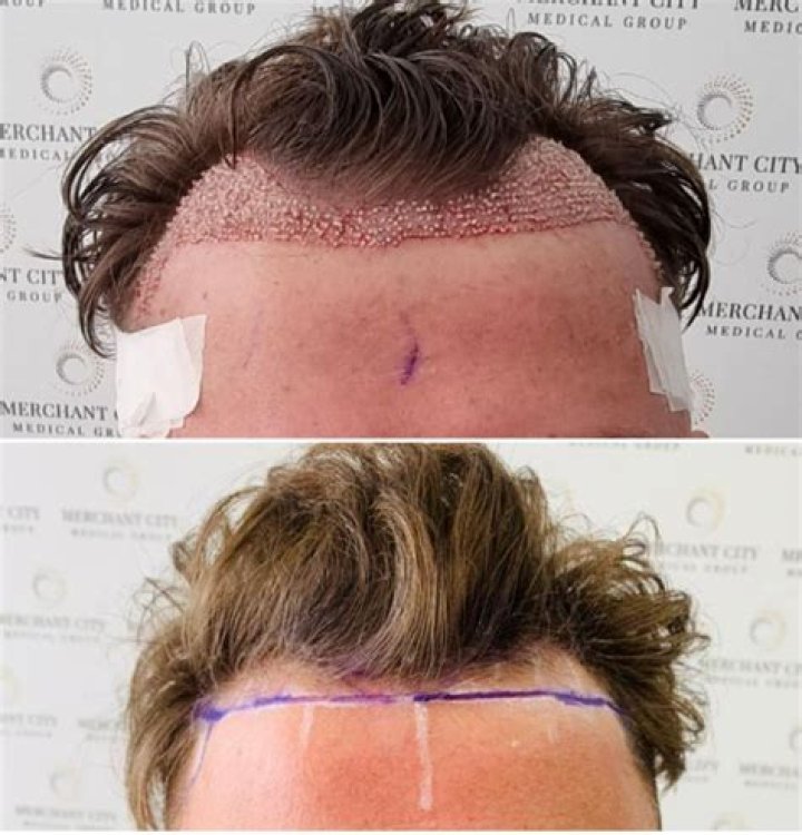How much does hair rejuvenation cost?