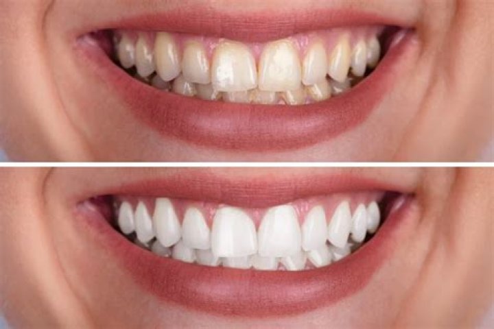 How much does it cost to get teeth whitened at Bright Dental?