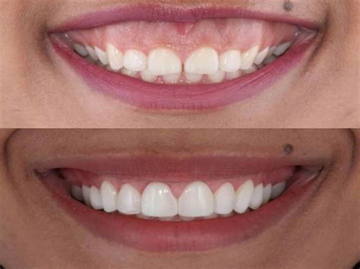 How much does laser gum treatment cost in India?