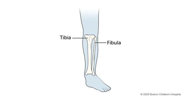 How much is a broken tibia and fibula worth?