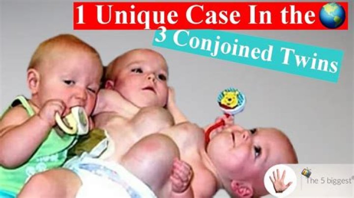 How rare is it to have conjoined triplets?