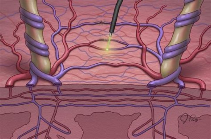 How successful is TTTS surgery?