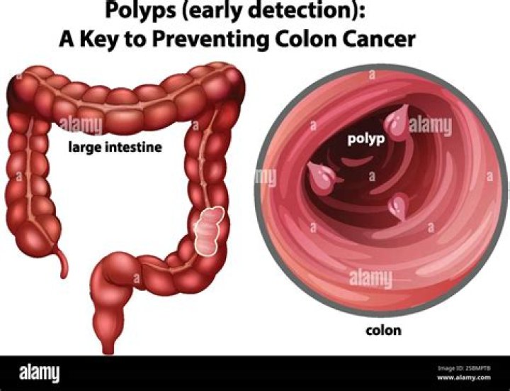 Is a 1 cm polyp big?