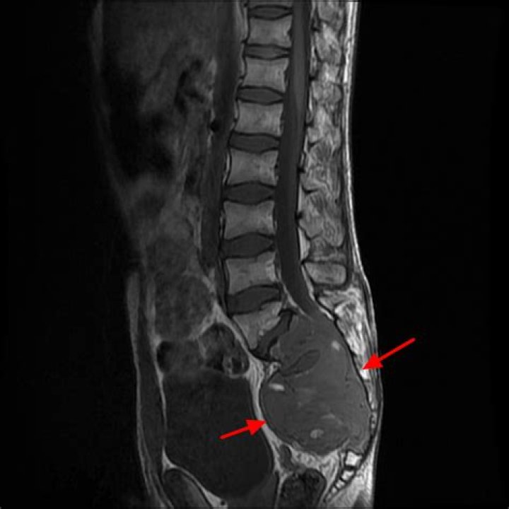 Is chordoma curable?