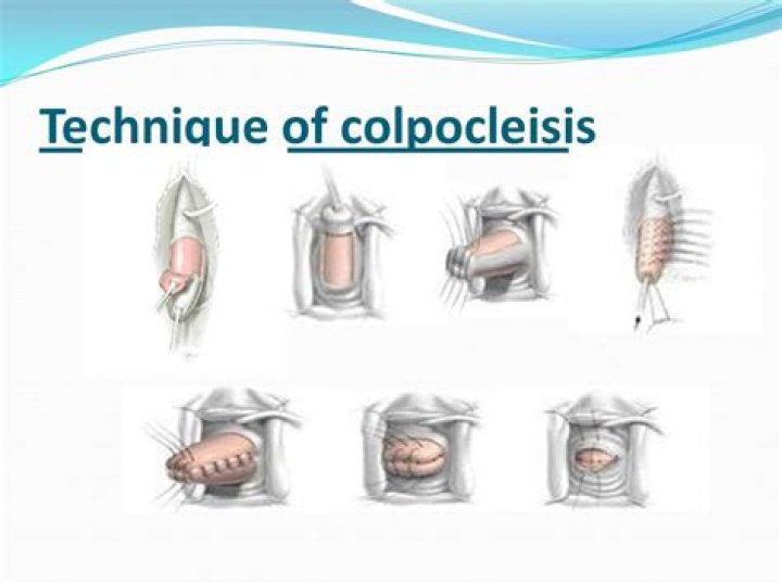 Is Colpocleisis reversible?