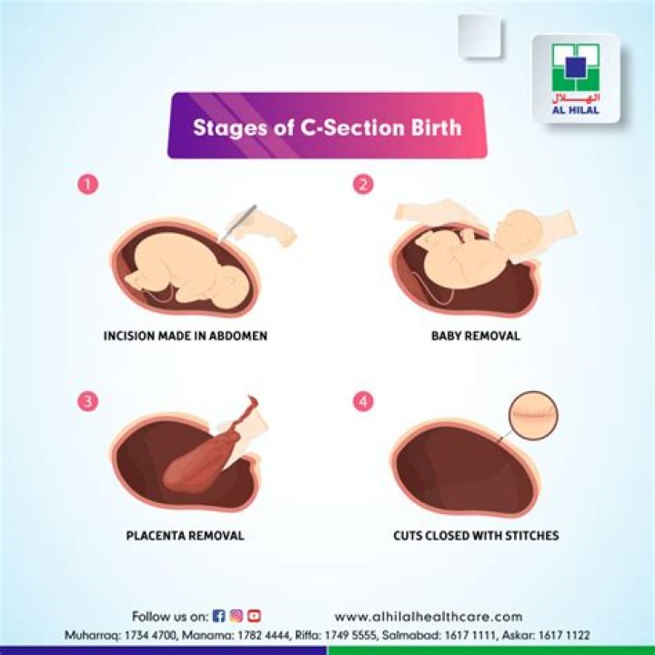 Is elective Cesarean safer than natural birth?