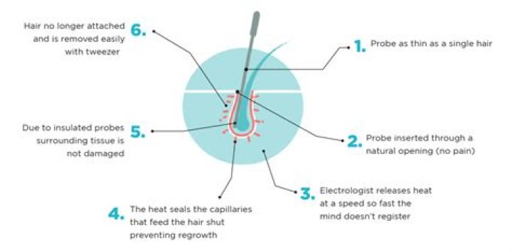 Is electronic tweezing permanent?