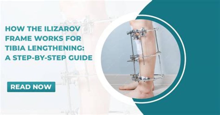 Is Ilizarov successful?