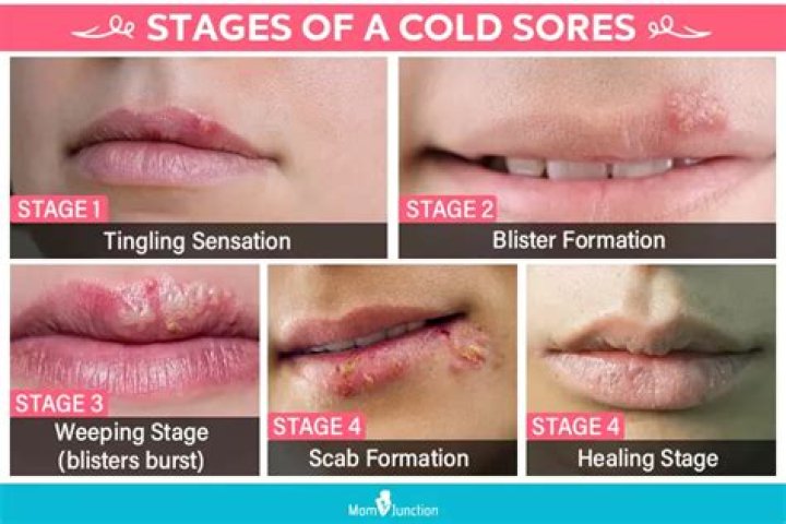 Is it common to get cold sores during pregnancy?