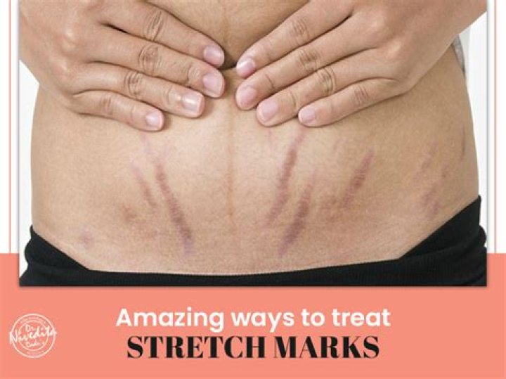 Is it normal for my stretch marks to hurt?