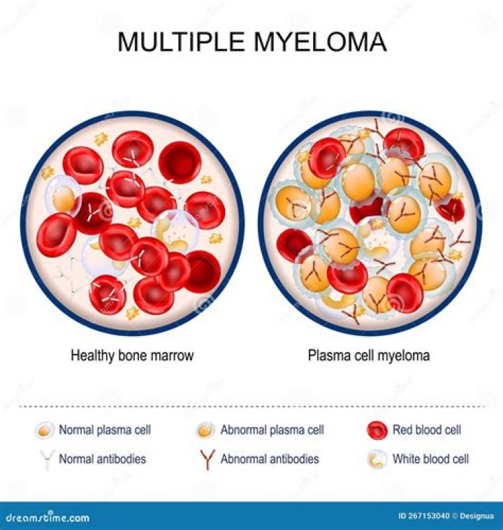 Is multiple myeloma a terminal?