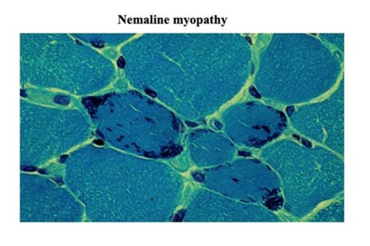 Is nemaline myopathy a muscular dystrophy?