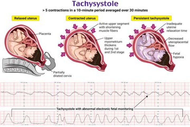 Is sinus tachycardia normal during pregnancy?