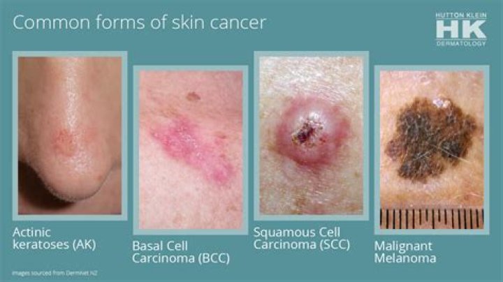Is skin cancer itchy and scaly?