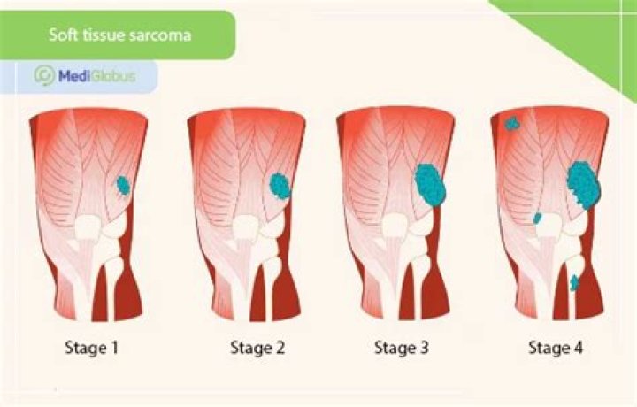 Is Stage 1 sarcoma curable?