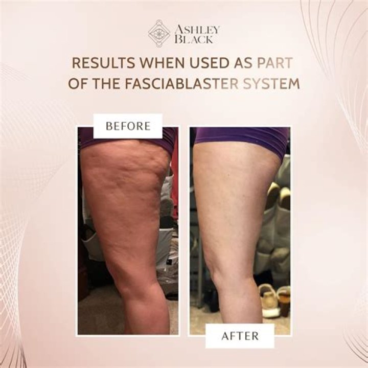 Is the fascia Blaster worth it?