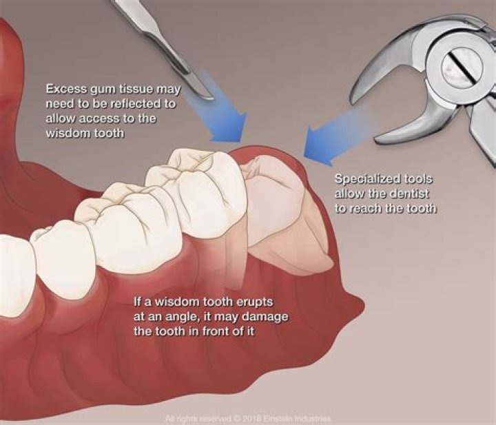 Is wisdom tooth extraction painful?