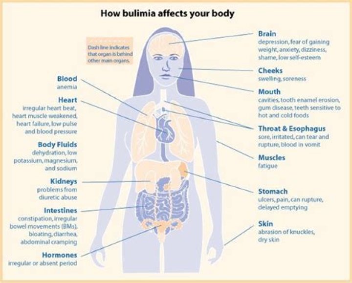 What are common medical complications associated with bulimia nervosa?