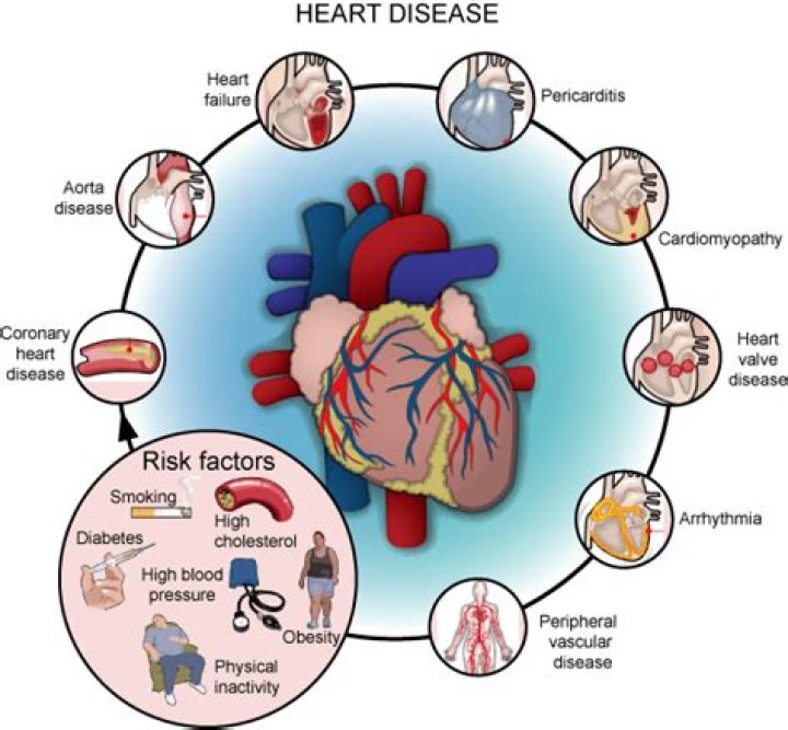 What are the 4 major risk factors of CAD?