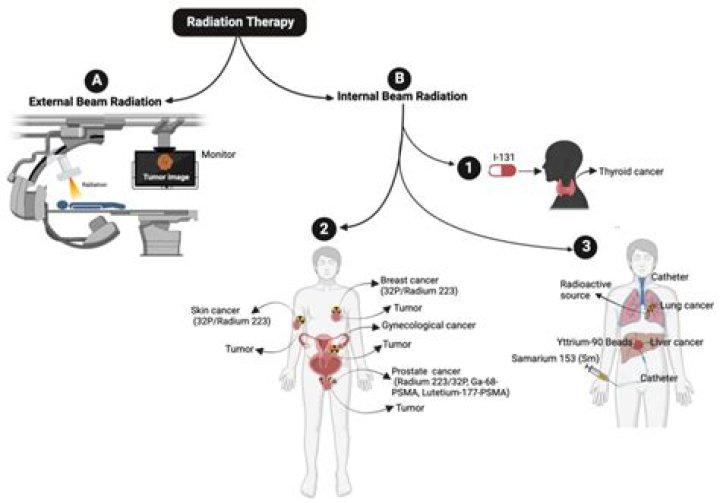 What are the different types of radiotherapy?