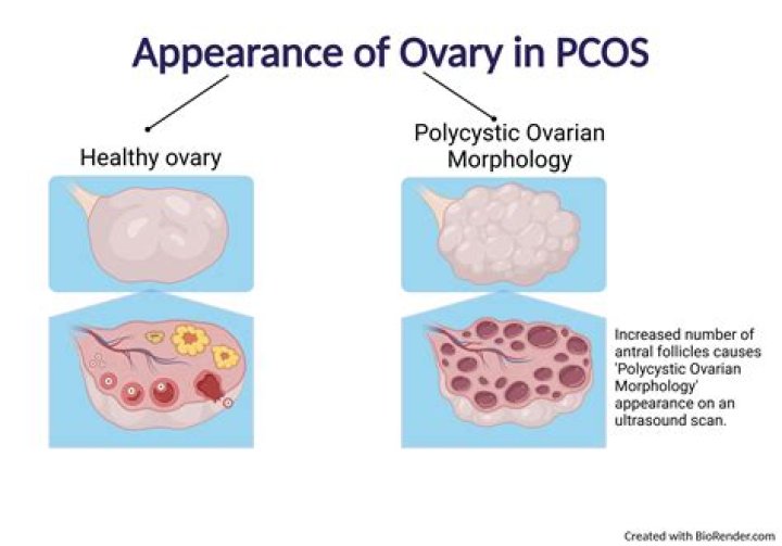 What are the side effects of having cysts on your ovaries?