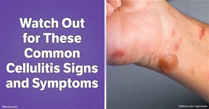 What are the signs and symptoms of cellulitis?